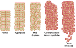 Tissue can be organized in a continous spectrum from normal to cancer.